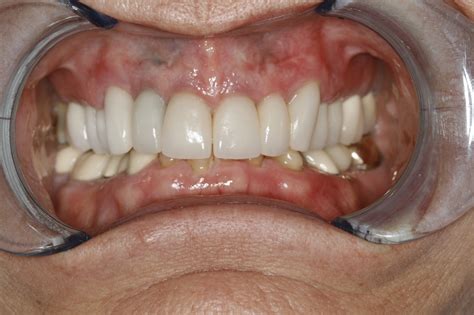 How To Fix An Overbite With Surgery / Overbite Blog Manchester ...