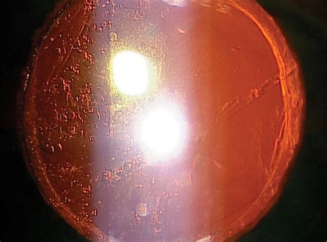 Take Charge of Cataract Care with Laser Capsulotomy