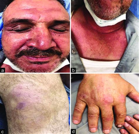 Dermatomyositis rash: (a) Heliotrope rash, (b) V shape rash, (c)... | Download Scientific Diagram