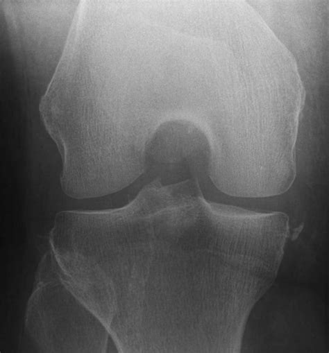 Segond fracture • LITFL Medical Blog • Medical Eponym Library