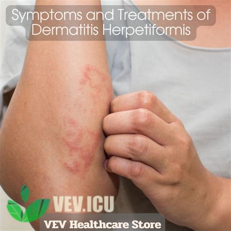 Dermatitis Herpetiformis Explained Symptoms Triggers And Relief ...