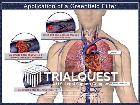 Application of a Greenfield Filter - TrialExhibits Inc.