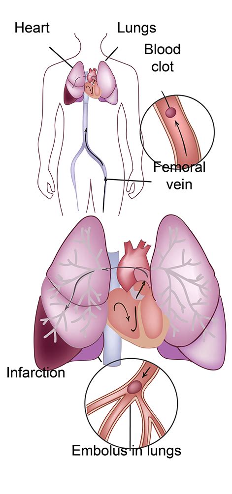 Pulmonary Embolism (PE) - Conditions and Treatments - LA Vascular ...