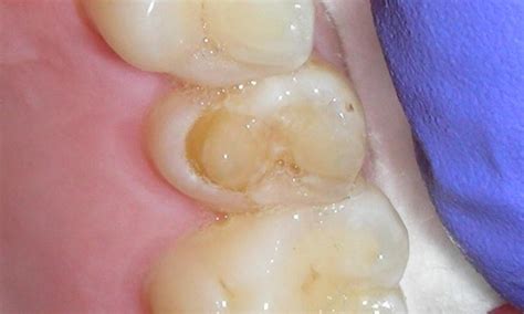 Enamel Repair with Composite Resin Before & After Photos | New Haven CT