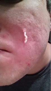 Mr. ZIT: Most 10 Shocking Popping Photo ! (Zits , Pimples and Acne)