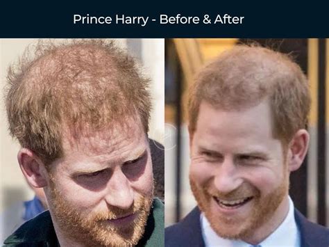 Prince Harry - Hair Transplant Before & After | Prince harry hair, Hair ...