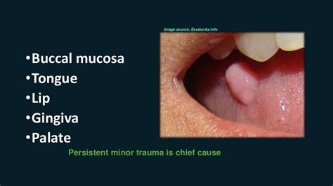 Oral Fibro-Epithelial Polyp