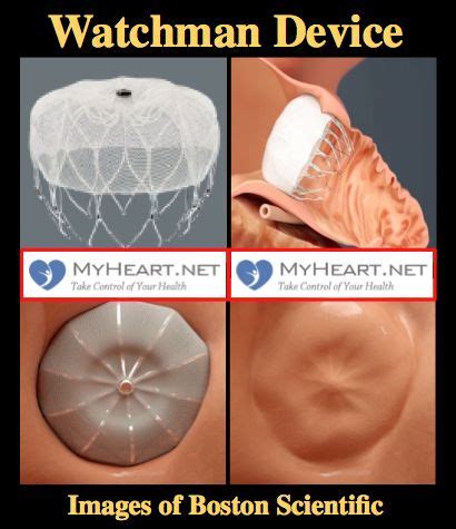 What is the Watchman Device (Also known as Watchman Procedure, Watchman Heart Procedure or ...