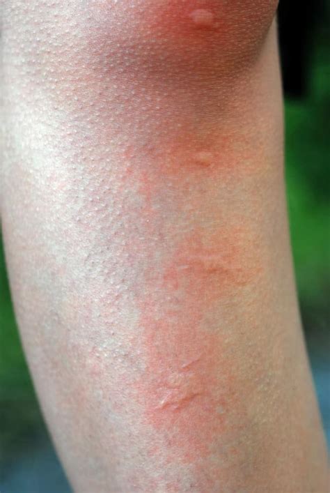 Mosquito Bite Allergy Symptoms Mosquito Bite Reaction Meaning | lupon.gov.ph