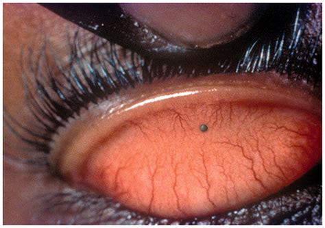 Severe Corneal Abrasion