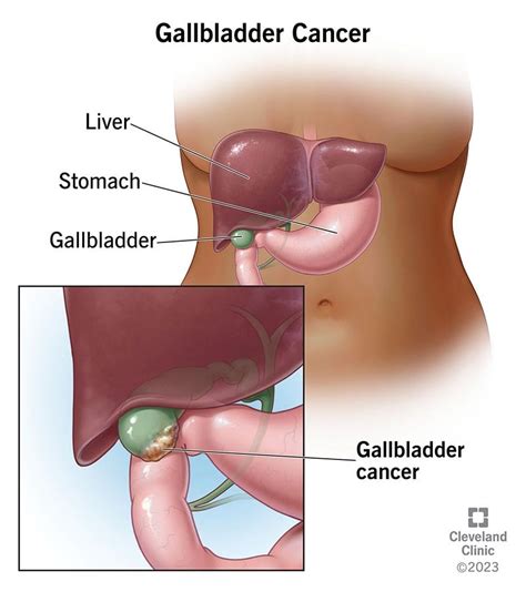 Signs And Symptoms Of Gallbladder Cancer - Ask The Nurse Expert