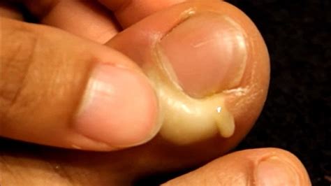 Paronychia! What Are Nail Infections? - YouTube