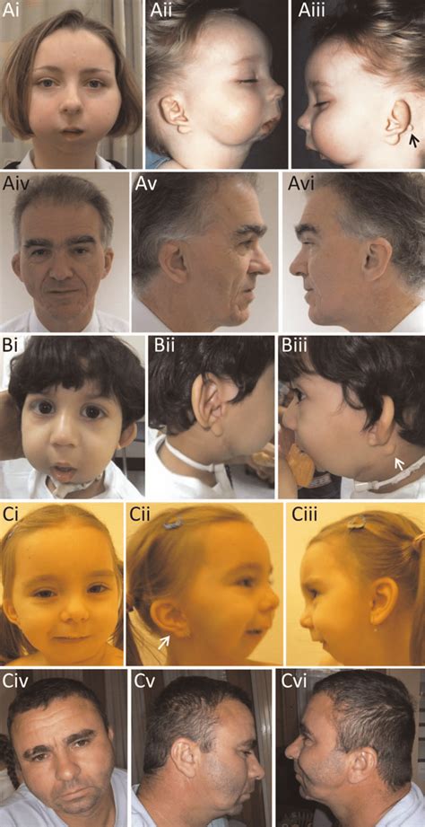 Craniofacial features of auriculocondylar syndrome patients harbouring ...