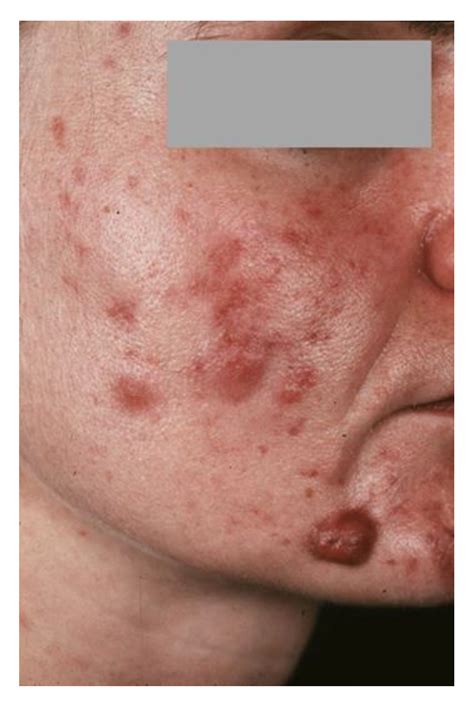 Rosacea Conglobata