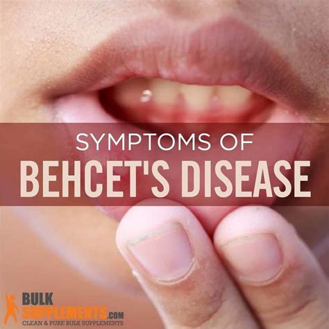 Tablo | Read 'Behcet’s Disease: Symptoms, Causes & Treatment' by