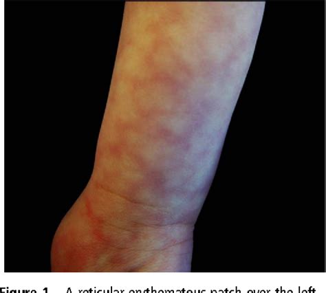 Figure 1 from Cutis marmorata telangiectatica congenital. | Semantic ...