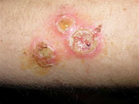 Staph Infection - Causes, Symptoms, Prevention, Treatment, Contagious | Diseases Pictures