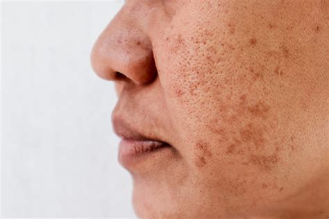 Enlarged Pores - Ozmedica Skin Clinic Melbourne