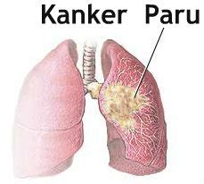 Pengobatan Kanker Paru Dengan Cryosurgery - Education Articles