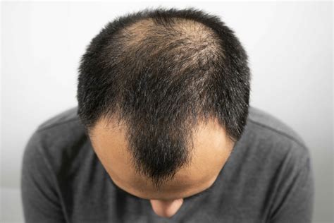 FDA-Approved Hair Loss Treatments for Androgenic Alopecia - HairScience