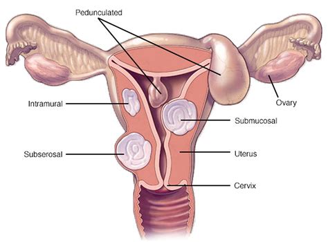 Uterine Fibroids - Causes, Symptoms, Diagnosis, Treatment & Pregnancy