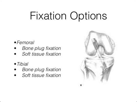 Acl graft fixation options