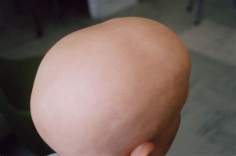 Alopecia Totalis - Symptoms, Causes and Treatment