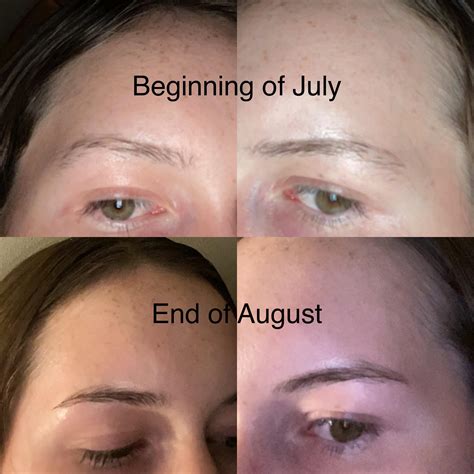 Almost 2 months of using minox on eyebrows consistently : r/minoxidil