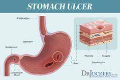 Stomach Ulcer Remedies, Stomach Ulcers, Stomach Acid, Gut Healing, Healing Process, Natural ...