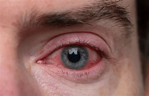 Why Are My Eyes Crusty In The Morning | Health Tips Now