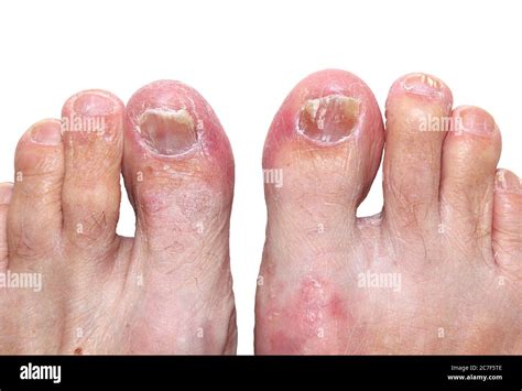 A moderate to severe case of athletes foot (tinea pedis) affecting the skin of the foot and toes ...