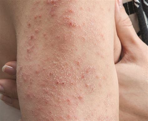 Celiac That's Skin Deep: The Mysterious Rash Sparked by Gluten | Celiac ...