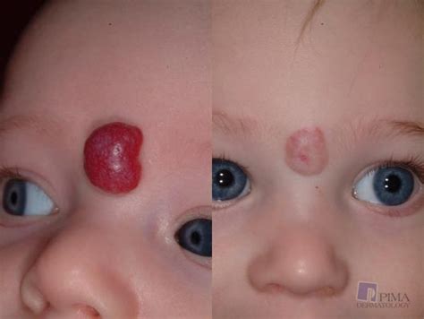 Hemangioma Baby Birthmark Removal by Tucson Dermatologists