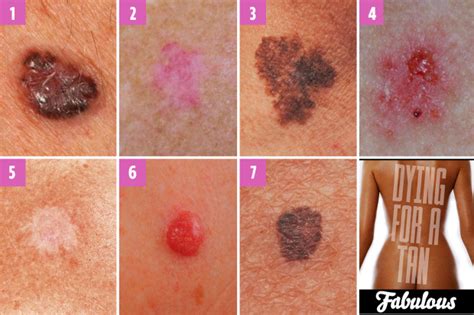 Can You Spot Which Moles Are Deadly? The Skin Cancer Signs You Need To CED