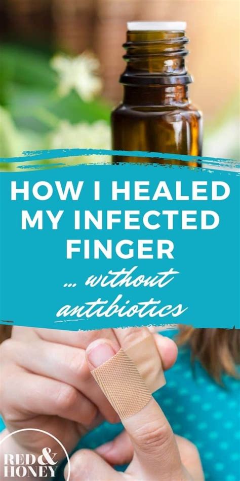 How I Healed My Infected Finger without Antibiotics - Red and Honey