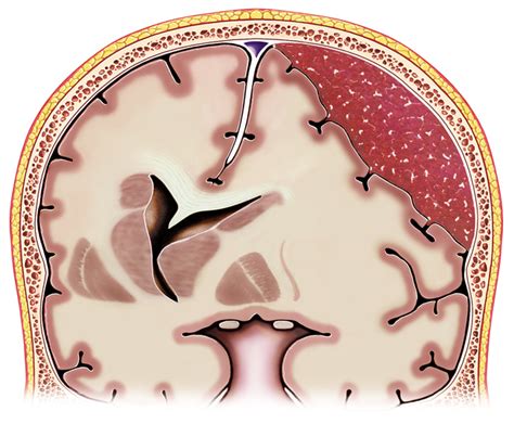 Hematomas Cerebrales Subdural Hematoma Brain Tissue Anatomy | The Best ...