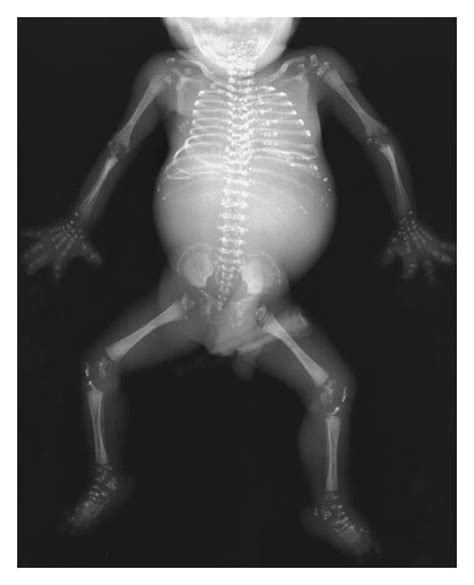 Chondrodysplasia Punctata | NEJM