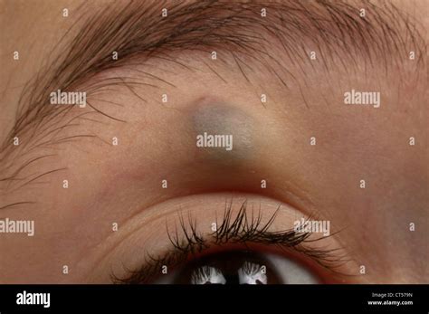 BENIGN SKIN TUMOR Stock Photo, Royalty Free Image: 49288001 - Alamy