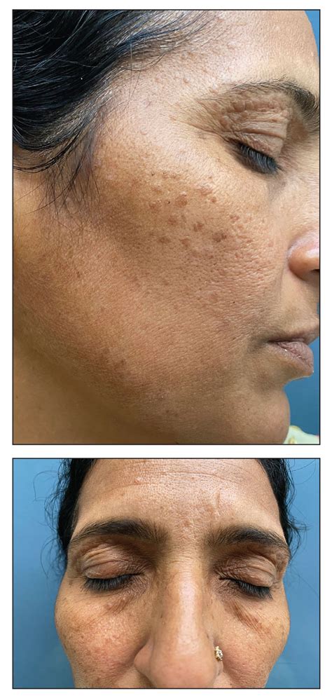 Pigmented Papules on the Face, Neck, and Chest | MDedge Dermatology