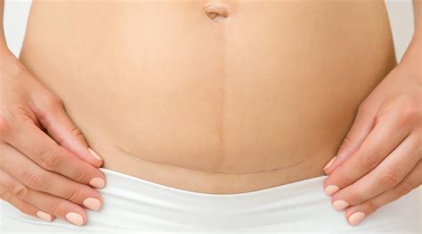 C Section Incision Before And After