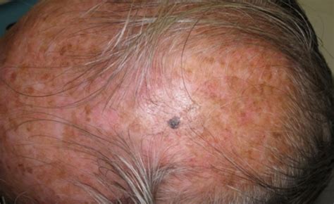 cancerous moles on scalp pictures | Symptoms and pictures