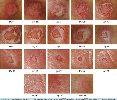 Skin Cancer Lesions Images