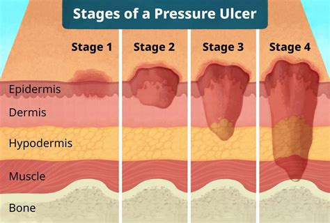Pressure Ulcers (Pressure Sores Or Bed Sores) Kriya Wound, 41% OFF