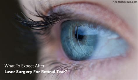 What To Expect After Laser Surgery For Retinal Tear by Dr. Himanshi