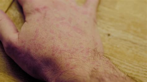 Food Allergy Lot Of Red Spots Rash On Skin Stock Footage SBV-347201027 - Storyblocks