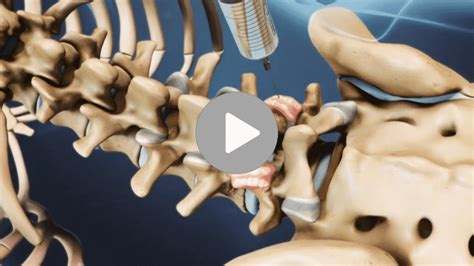 Facet Joint Injections | Atlanta | AllSpine Laser & Surgery