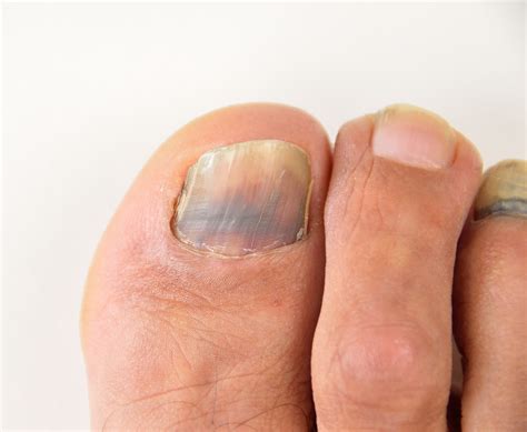 Melanoma Brown Spot On Toenail : What are the Different Types of Malignant Melanoma ... : If you ...