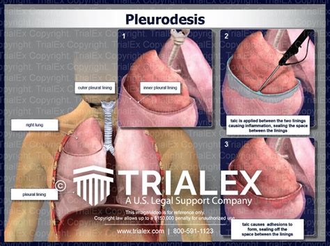 Pleurodesis - Trial Exhibits Inc.