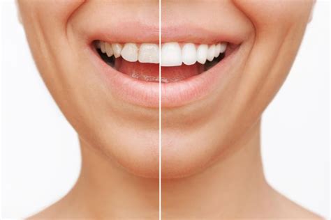 Veneers VS Lumineers: The Main Differences | Pros and Cons