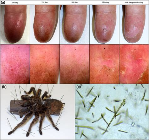 Image Gallery: Contact dermatitis resulting from tarantula‐hair injury mimicking ischaemia: a ...